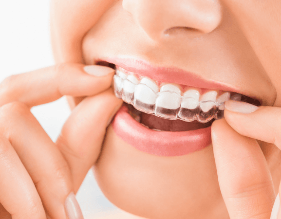 Benefits of Invisalign