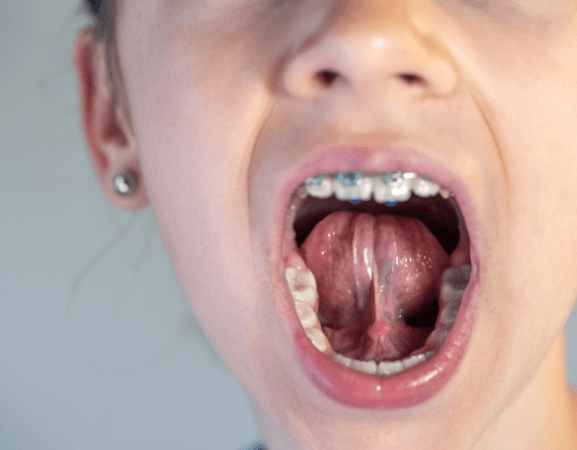 Braces And Tongue Tie Oral Examination