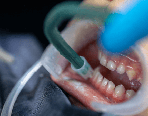 Teeth Cleaning With Dental Suction Tool
