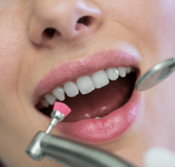 Dental Teeth Cleaning And Polishing Procedure