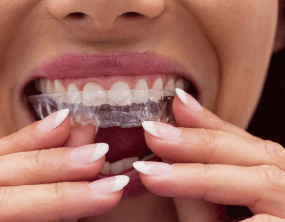 Clear Teeth Aligners For Straightening Teeth