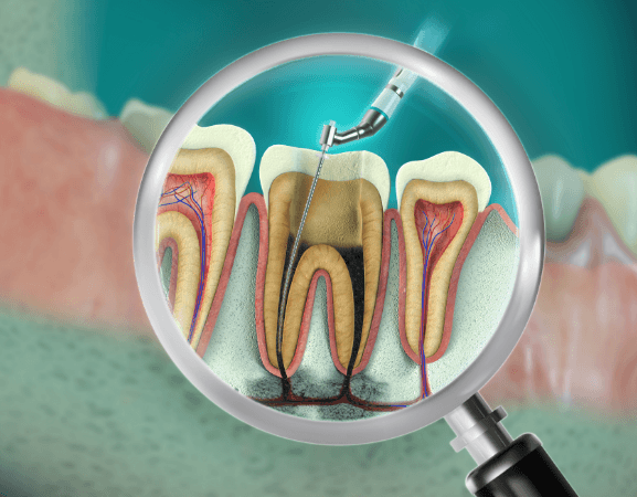 The process of endodontic root canal treatment