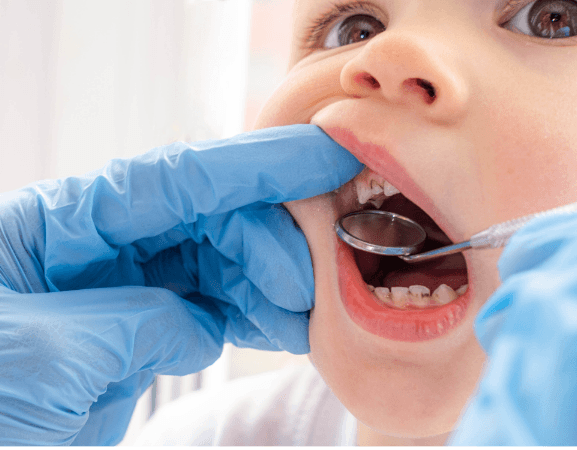 Teeth Cleanings for Children