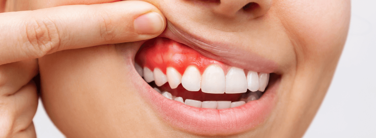Red Swollen Gums And Gum Infection