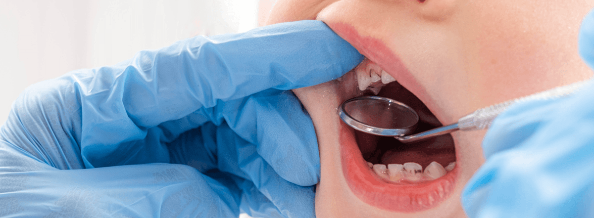 cavity-broken-tooth-banner