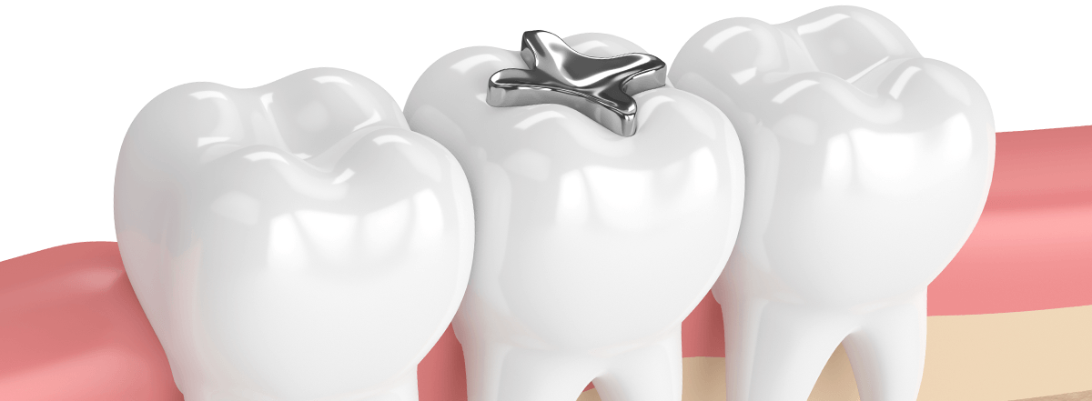 Amalgam Filling Treatment