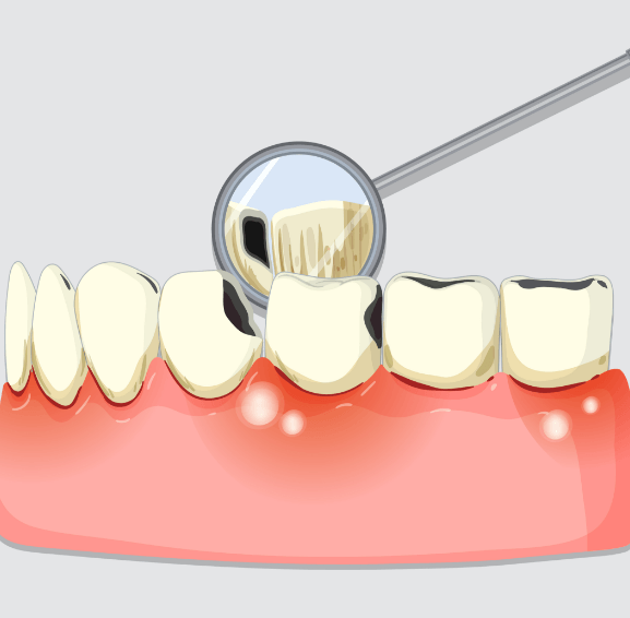 tooth colored fillings